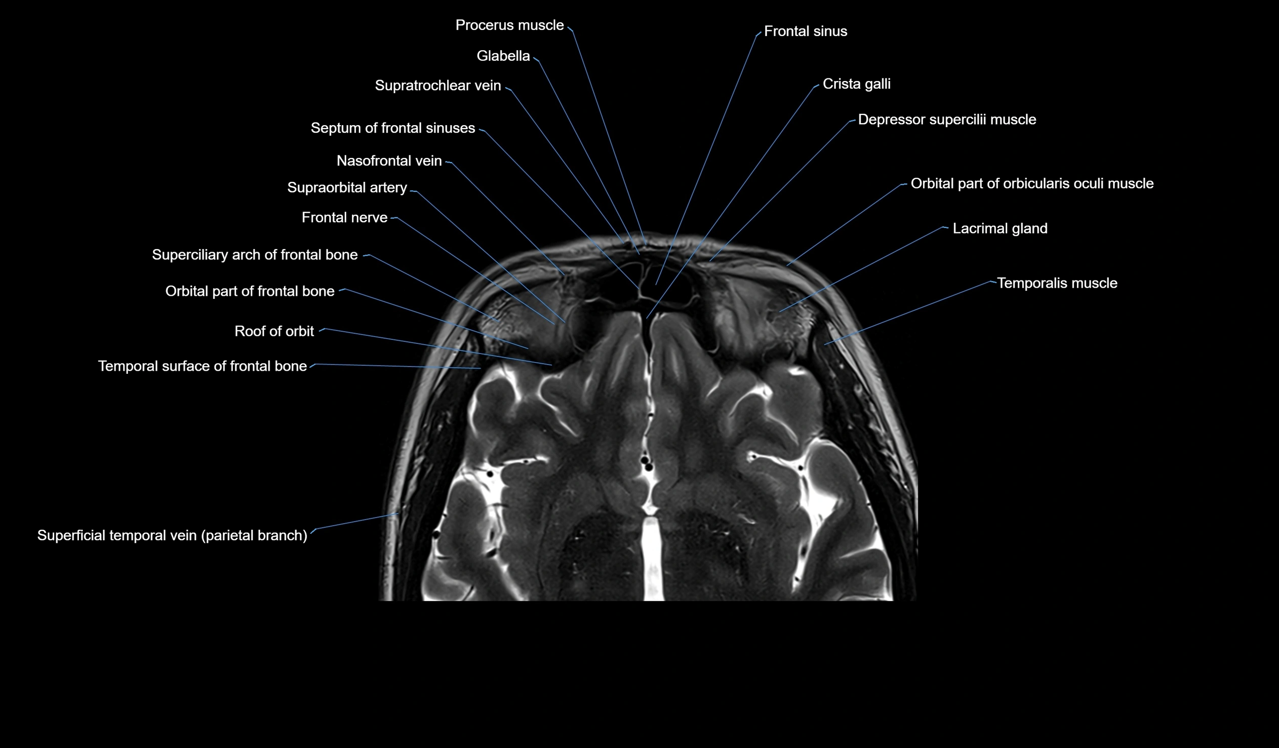 MRI face & paranasal sinuses(PNS) labelled  coronal  cross sectional anatomy 3T radiology  image-img-00001-00027.webp